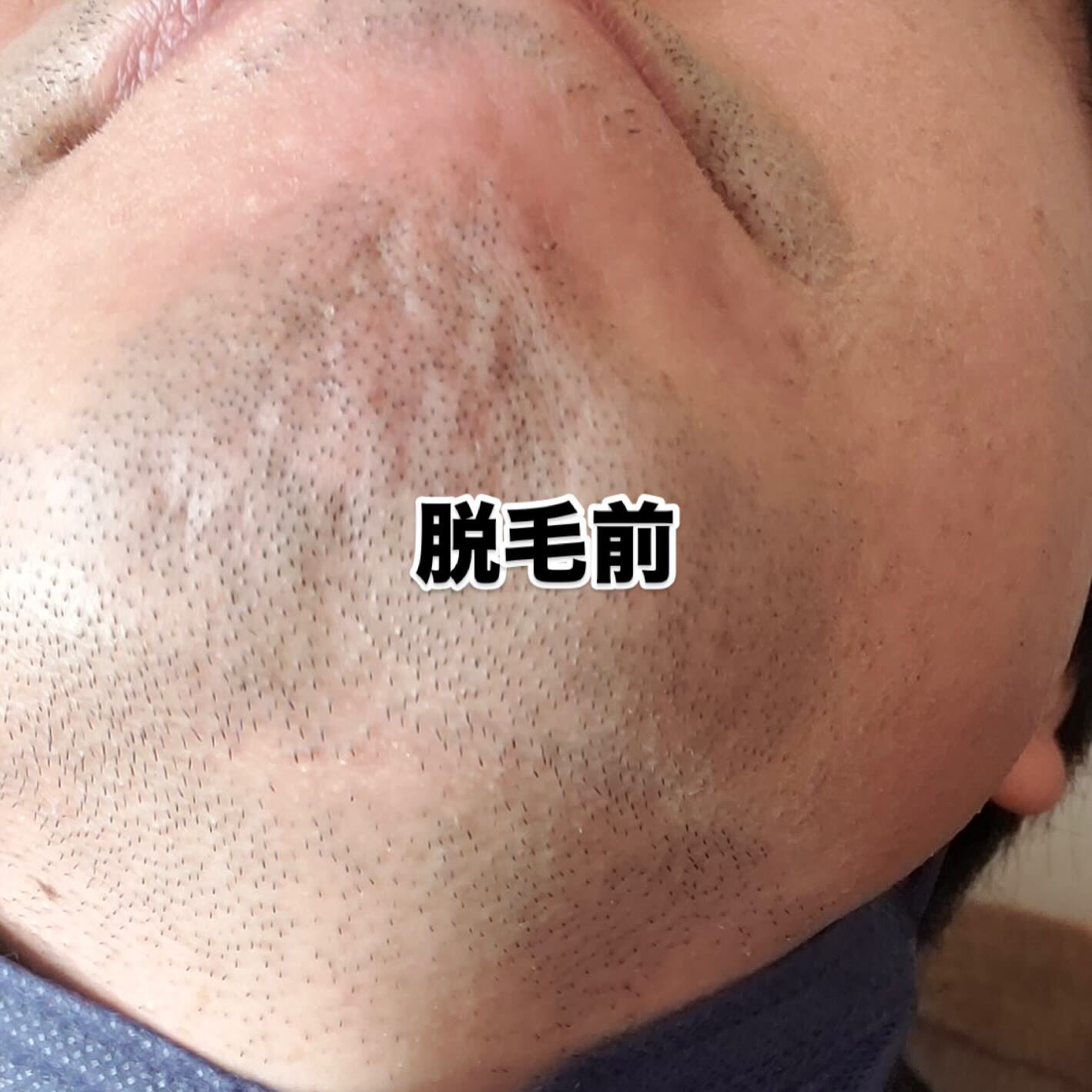 スキンエッグは、光を用いた高性能な脱毛機器を使用し、お客様一