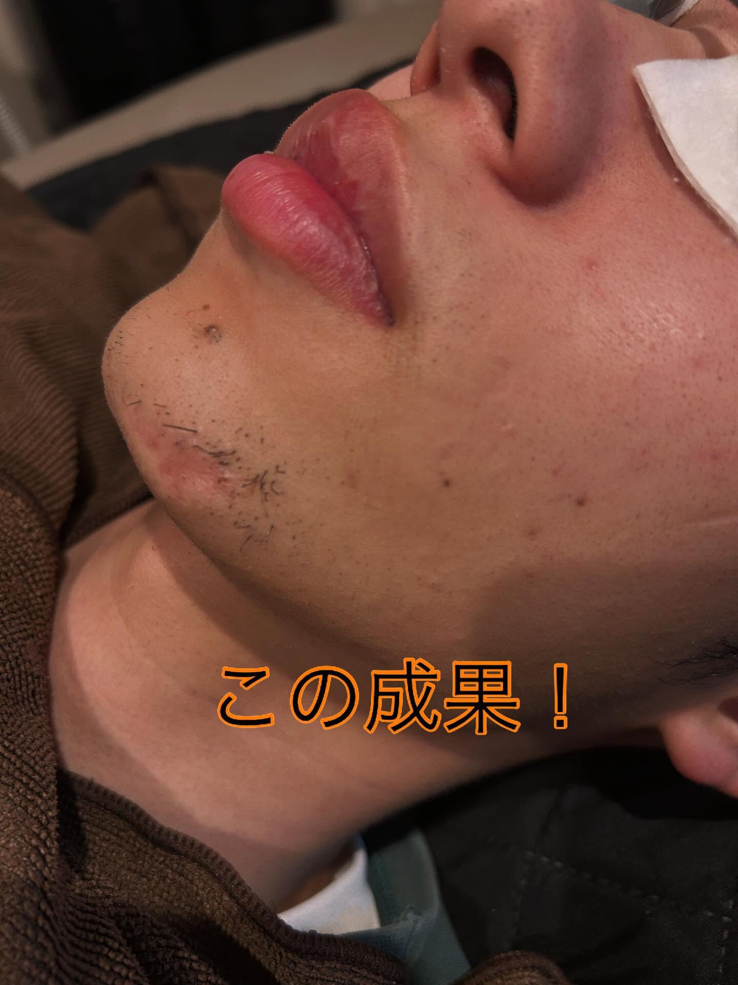 ❗️初めての方も大歓迎❗️光脱毛のワンダフルな効果を体験しま
