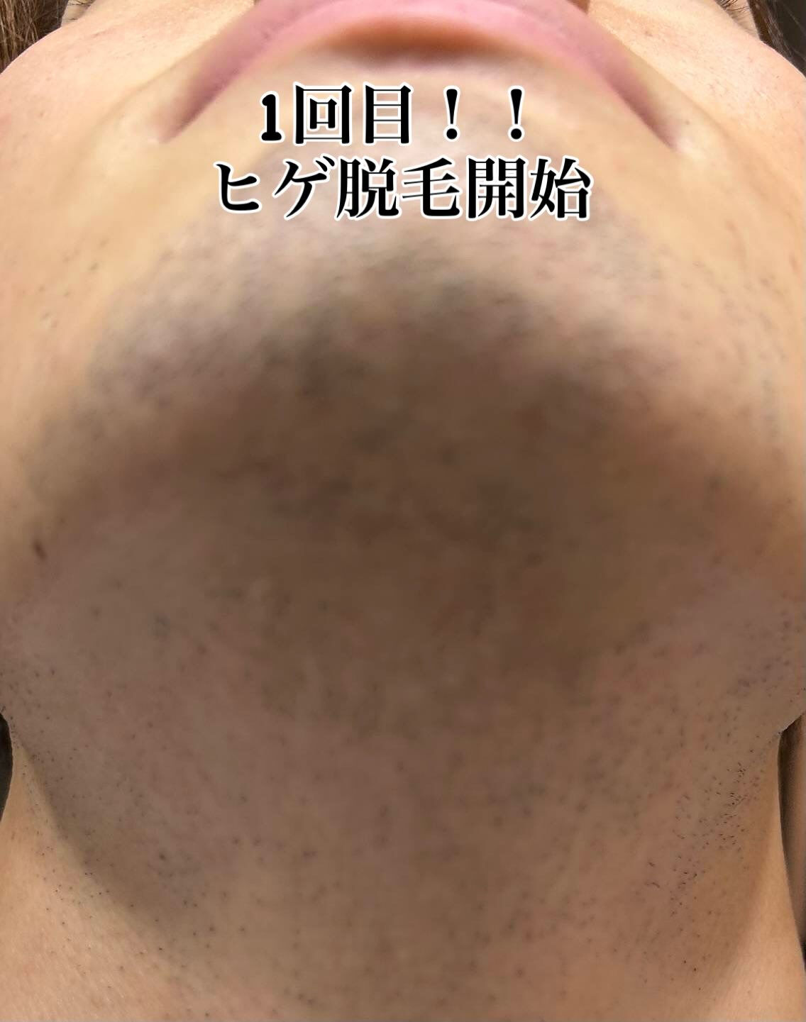 こちらの素敵なお客様がついに18回目のヒゲ脱毛を完了しました