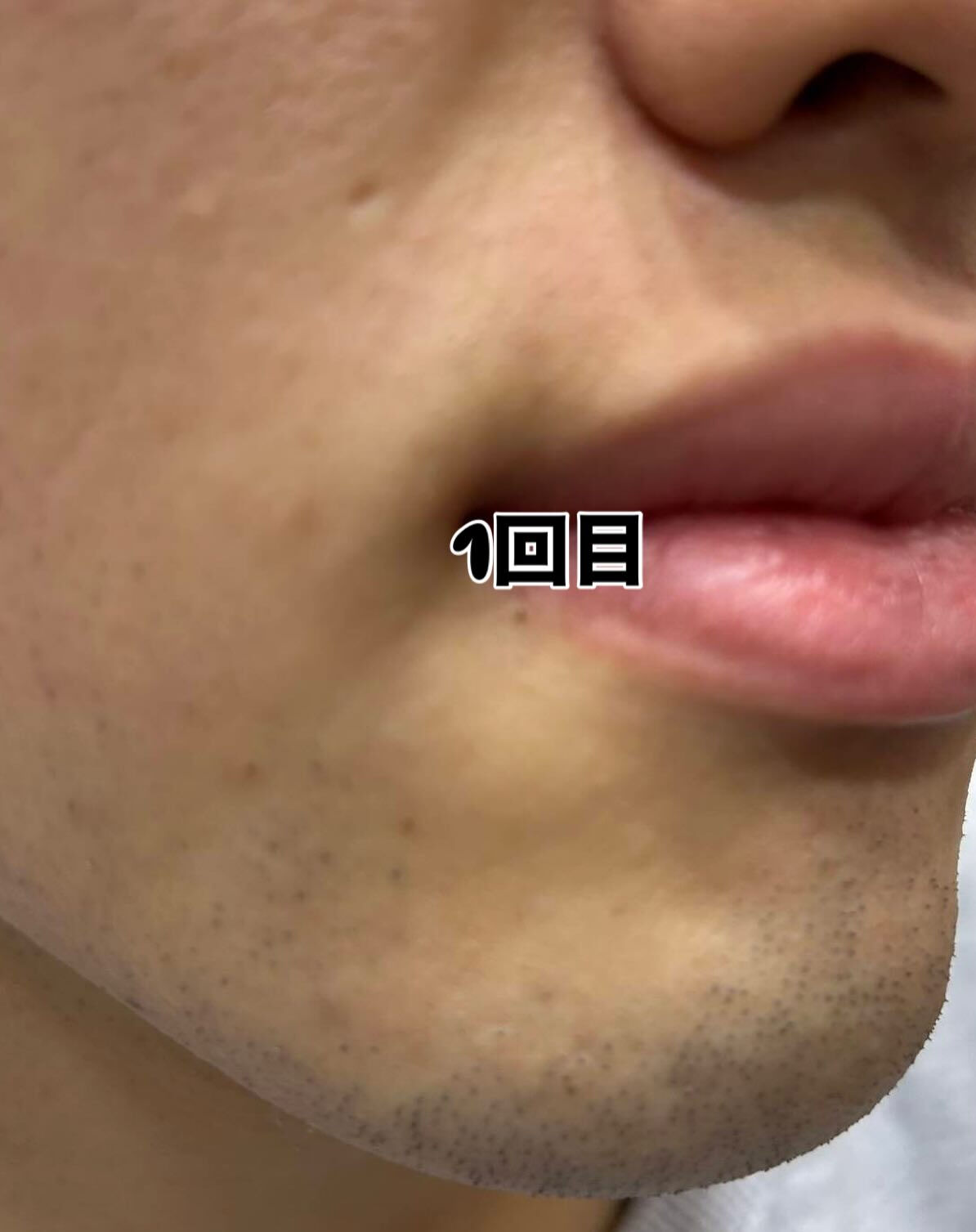 こちらの素敵なお客様がついに18回目のヒゲ脱毛を完了しました